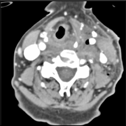 Induration of Left Neck - CTisus CT Scan