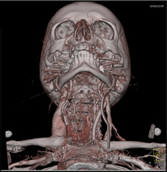 Prominent Right Jugular Vein - CTisus CT Scan