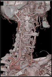 Carotid Stenosis - CTisus CT Scan