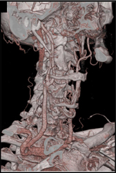 Carotid Stenosis - CTisus CT Scan