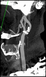 Carotid Stenosis - CTisus CT Scan