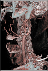 Carotid Stenosis - CTisus CT Scan