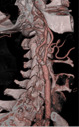 Carotid Stenosis - CTisus CT Scan