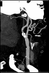 Carotid Stenosis - CTisus CT Scan