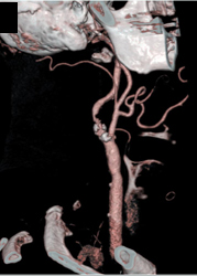 Carotid Stenosis - CTisus CT Scan