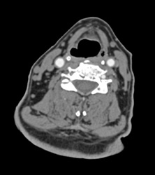 Carotid Artery Stenosis - CTisus CT Scan