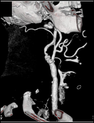 Carotid Artery Stenosis - CTisus CT Scan