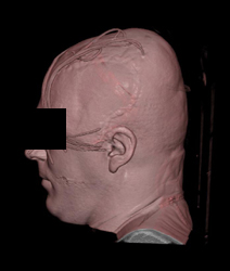 Craniotomy - CTisus CT Scan