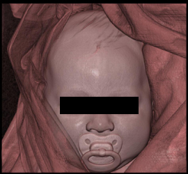 Plagiocephaly - CTisus CT Scan