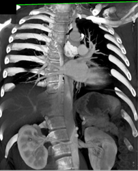 Craniofacial Visualization - CTisus CT Scan