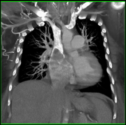 Facial Trauma With Repair - CTisus CT Scan