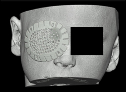 Orbital Trauma - CTisus CT Scan