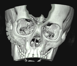 Orbital Trauma - CTisus CT Scan