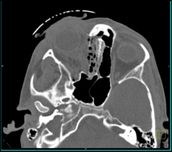 Orbital Trauma - CTisus CT Scan