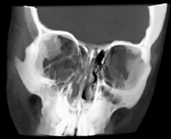 Orbital Trauma - CTisus CT Scan