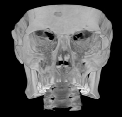 Orbital Trauma - CTisus CT Scan