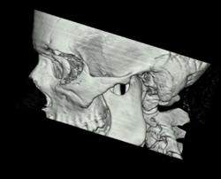 Orbital Trauma - CTisus CT Scan