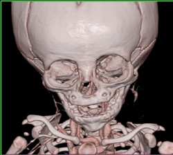 VRT to Show Bone - CTisus CT Scan