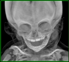 Different Opacities of VRT - CTisus CT Scan