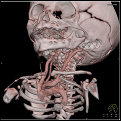 Nice CTA of Carotid Aa - CTisus CT Scan