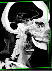 Normal Intracranial Circulation - CTisus CT Scan