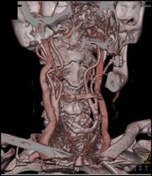 Carotid Artery Plaque - CTisus CT Scan