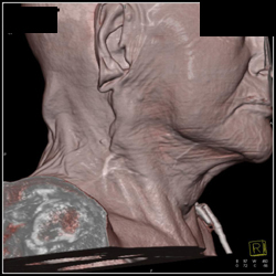 Prior H and N Resection - CTisus CT Scan