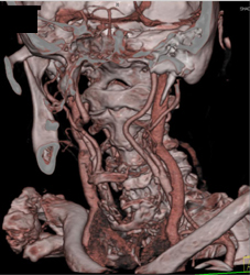 Normal Carotid Bifurcations - CTisus CT Scan