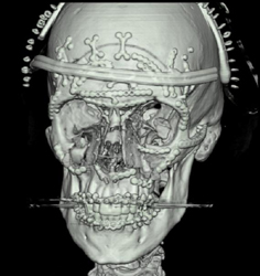 S/P Craniotomy - CTisus CT Scan