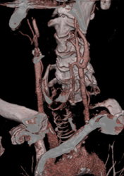 Calcified Plaque - CTisus CT Scan