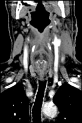 Right and Left Mild Carotid Artery Stenosis - CTisus CT Scan