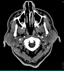 Polyps in Maxillary Sinus - CTisus CT Scan