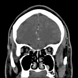 Polyps in Maxillary Sinus - Neuro Case Studies - CTisus CT Scanning