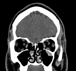 Normal Orbital Muscles - CTisus CT Scan