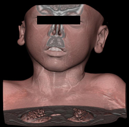 Normal CTA With Various Rendering - CTisus CT Scan