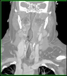 Tumor in Left Hypopharynx Involves Airway - CTisus CT Scan