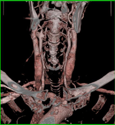 Minimal Carotid Plaque - CTisus CT Scan