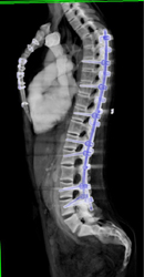 Post-op Angioma S/P Spinal Surgery - CTisus CT Scan