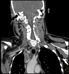 Jugular Vein Thrombosis (JVT) - CTisus CT Scan