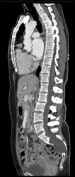 Dural Ectatic- Marfan Syndrome - CTisus CT Scan