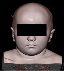 Different Rendering of the Face - CTisus CT Scan