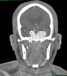 Bilateral Internal Carotid Artery Aneurysms - CTisus CT Scan