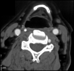 Carotid Artery Stenosis - CTisus CT Scan