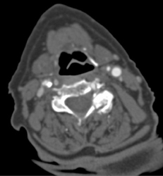 Carotid Artery Stenosis - CTisus CT Scan