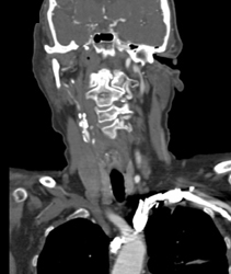 Carotid Artery Stenosis - CTisus CT Scan