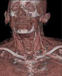 Normal Neck Anatomy - CTisus CT Scan