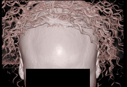 Nice Hair - CTisus CT Scan