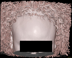 Volume Rendering of Hair - CTisus CT Scan