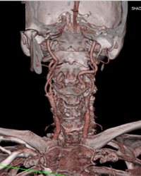 Diseased Carotid Arteries - CTisus CT Scan