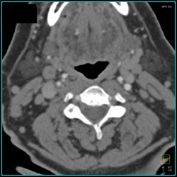 Carotid Stenosis - CTisus CT Scan